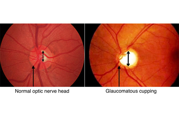 Glaucoma