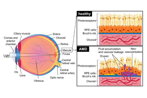 Macular Degeneration